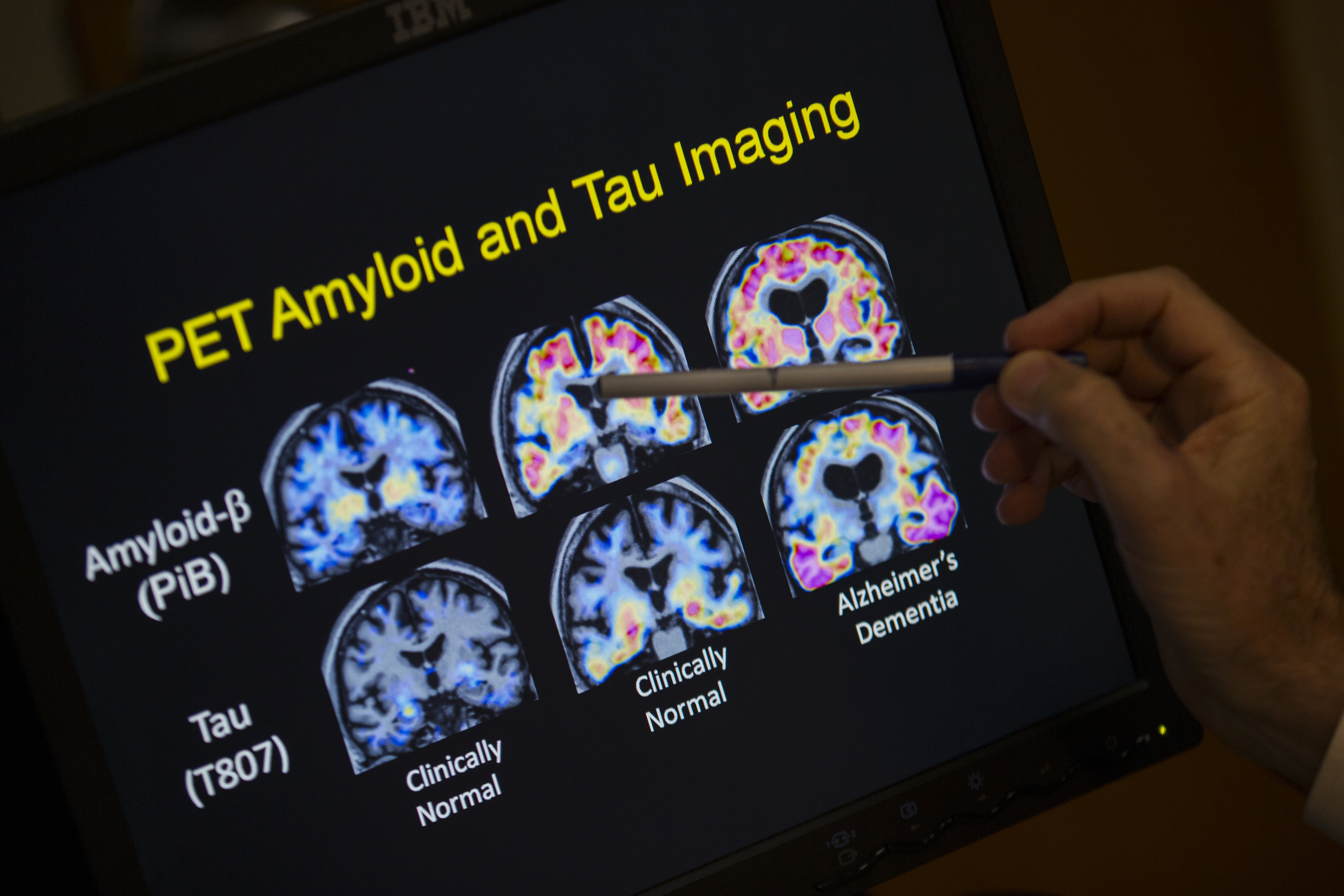 FILE - R. Scott Turner, Professor of Neurology and Director of the Memory Disorder Center at Georgetown University Hospital, points to PET scan results that are part of a study on Alzheimer's disease at Georgetown University Hospital in Washington, May 19, 2015. (AP Photo/Evan Vucci, File)