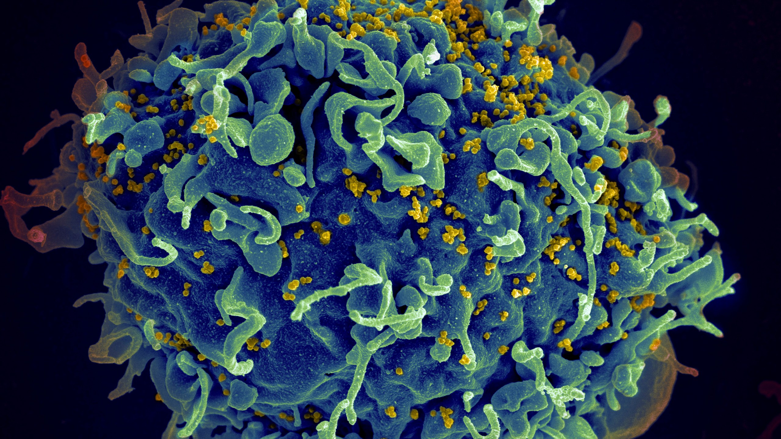 FILE - This colorized electron microscope image provided by the U.S. National Institutes of Health shows a human T cell, in blue, under attack by HIV, in yellow, the virus that causes AIDS. (Seth Pincus, Elizabeth Fischer, Austin Athman/National Institute of Allergy and Infectious Diseases/NIH via AP, File)