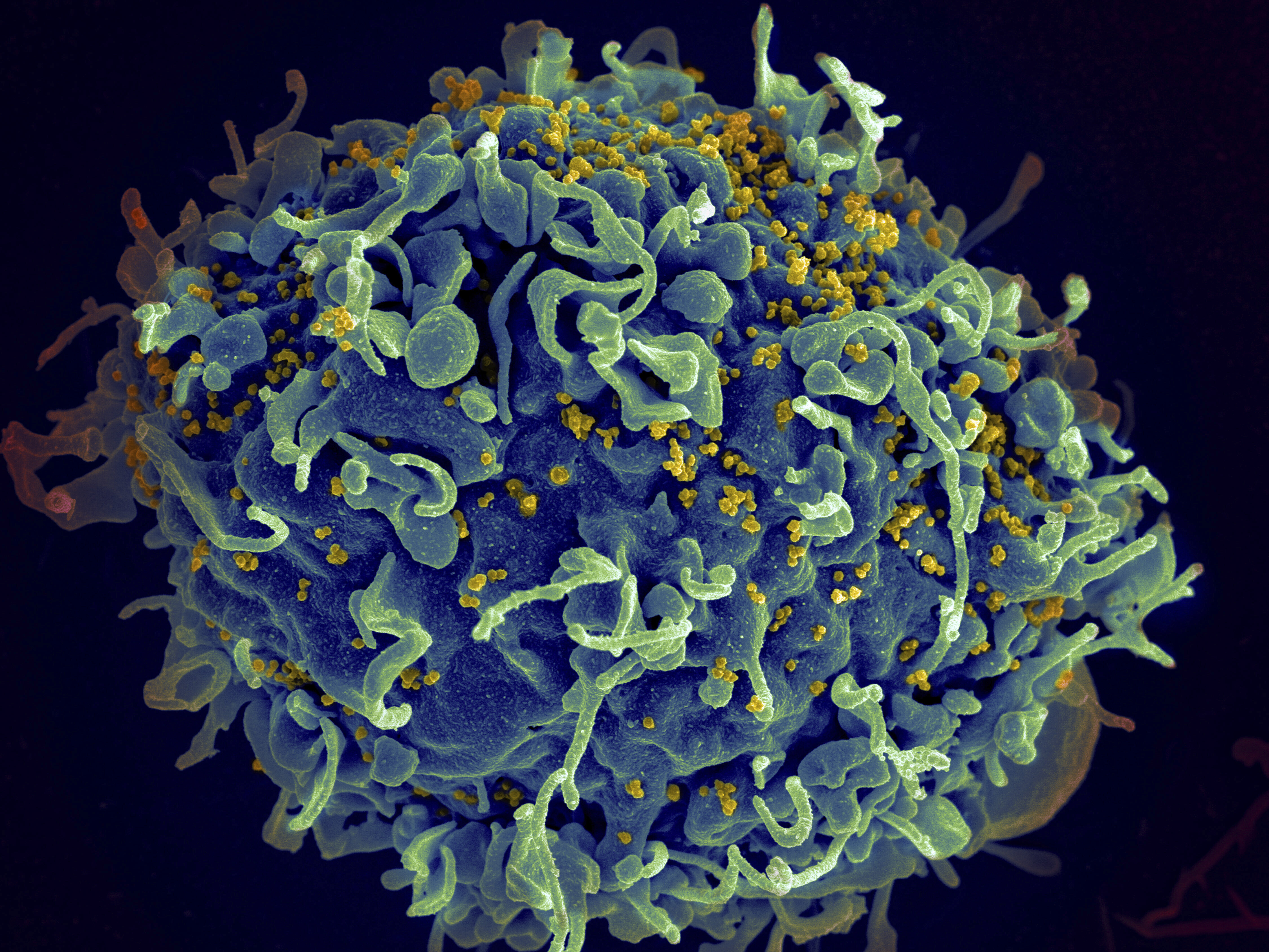 FILE - This colorized electron microscope image provided by the U.S. National Institutes of Health shows a human T cell, in blue, under attack by HIV, in yellow, the virus that causes AIDS. (Seth Pincus, Elizabeth Fischer, Austin Athman/National Institute of Allergy and Infectious Diseases/NIH via AP, File)
