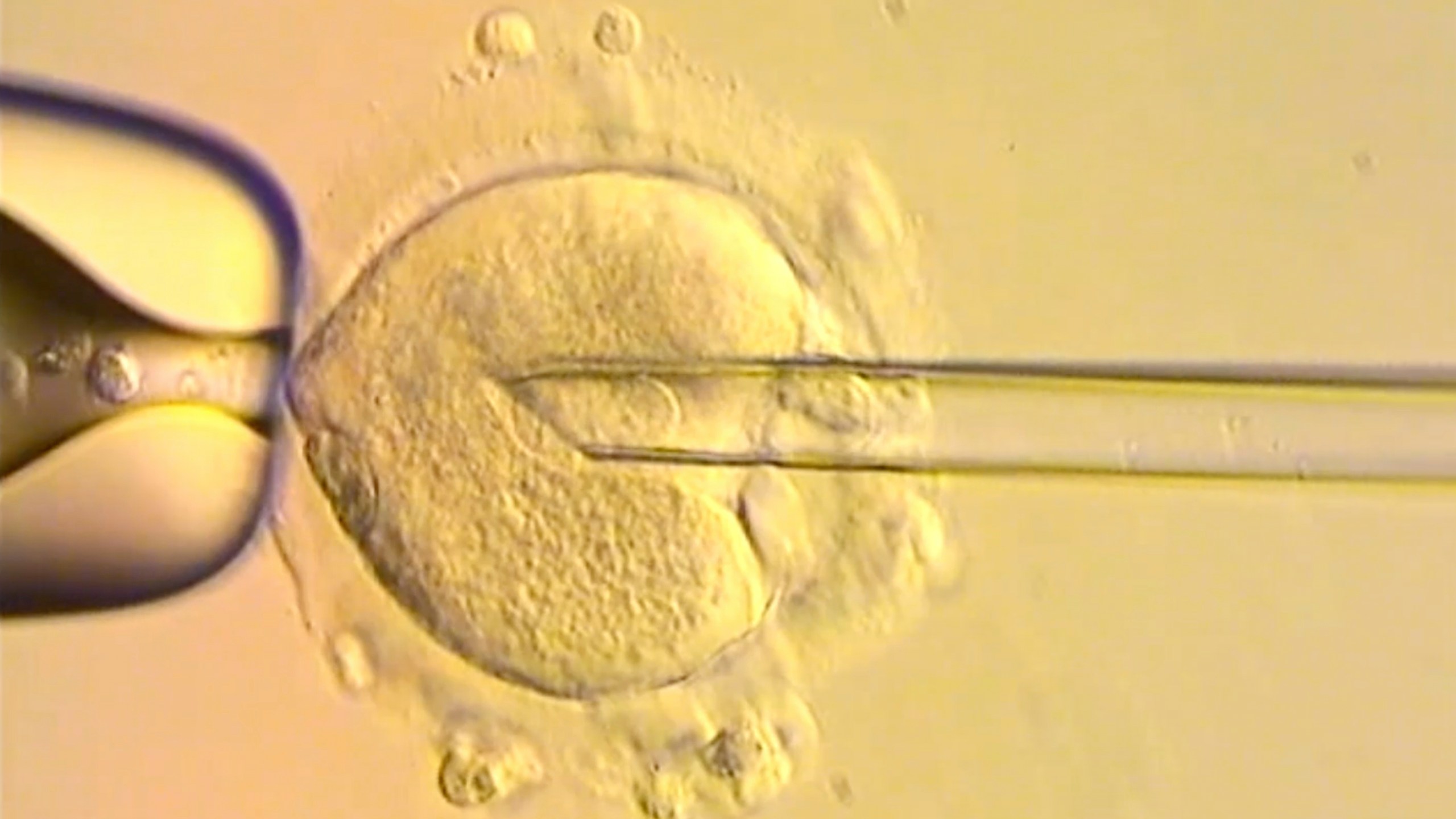 This image from video provided by the Newcastle Fertility Centre shows a nuclear genome from an egg carrying a mitochondrial DNA mutation being inserted into an egg donated by an unaffected woman. (Newcastle Fertility Centre, Newcastle Hospitals NHS Foundation Trust via AP)