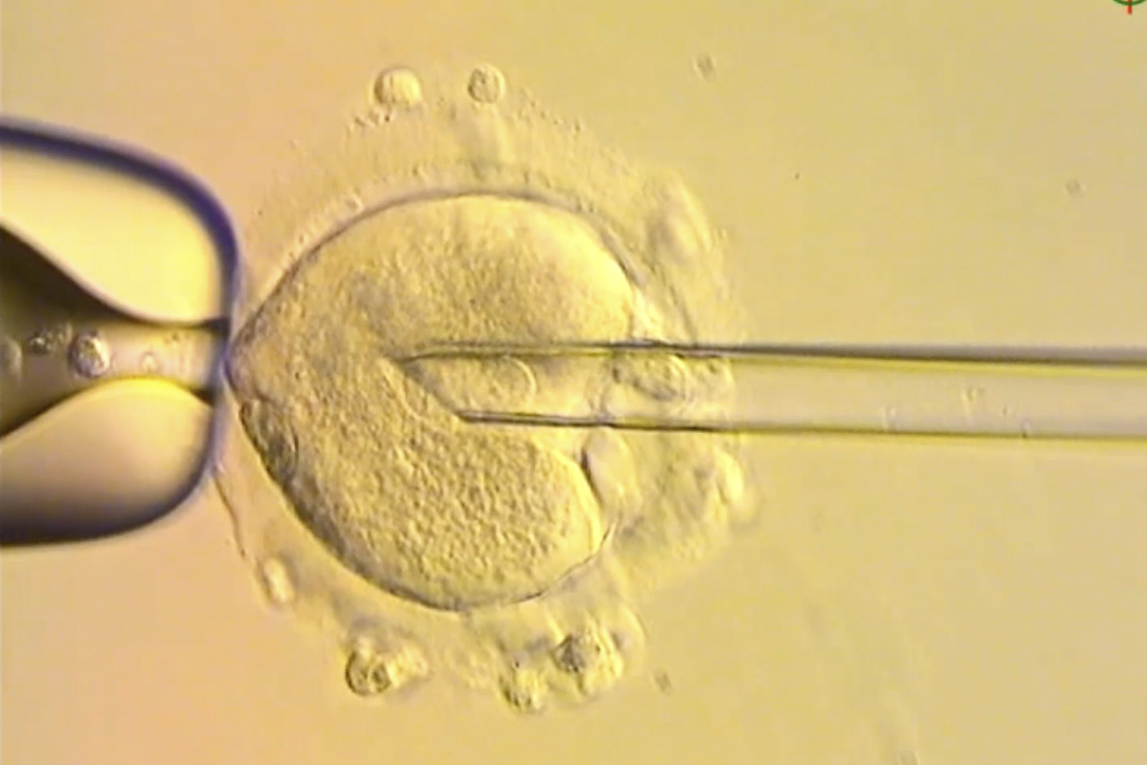 This image from video provided by the Newcastle Fertility Centre shows a nuclear genome from an egg carrying a mitochondrial DNA mutation being inserted into an egg donated by an unaffected woman. (Newcastle Fertility Centre, Newcastle Hospitals NHS Foundation Trust via AP)