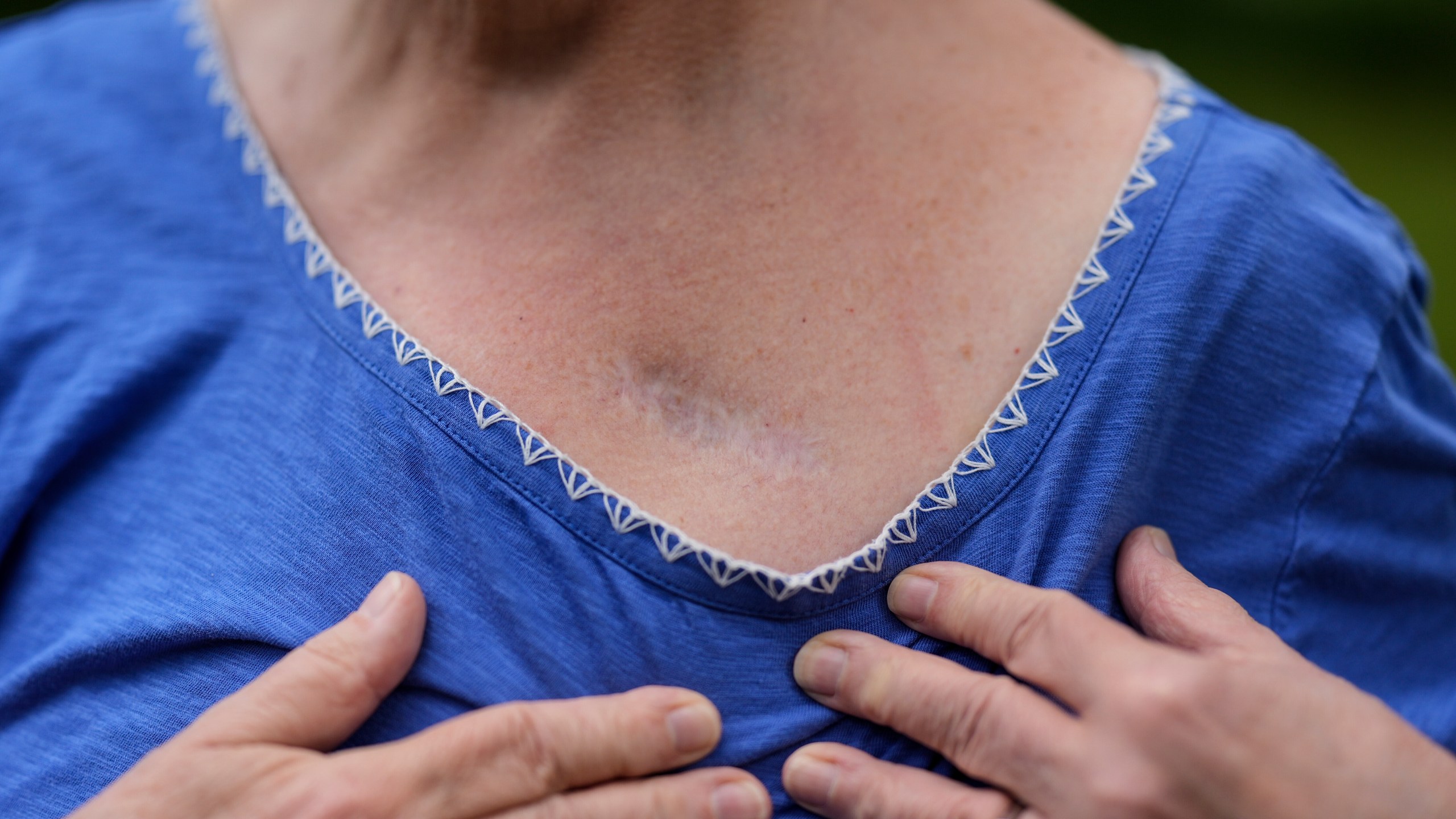 Carol Seegar shows where her deep brain stimulator, powered by an Abbott Brio IPG, was implanted in her body, Thursday, July 24, 2025, in Atlanta. (AP Photo/Mike Stewart)