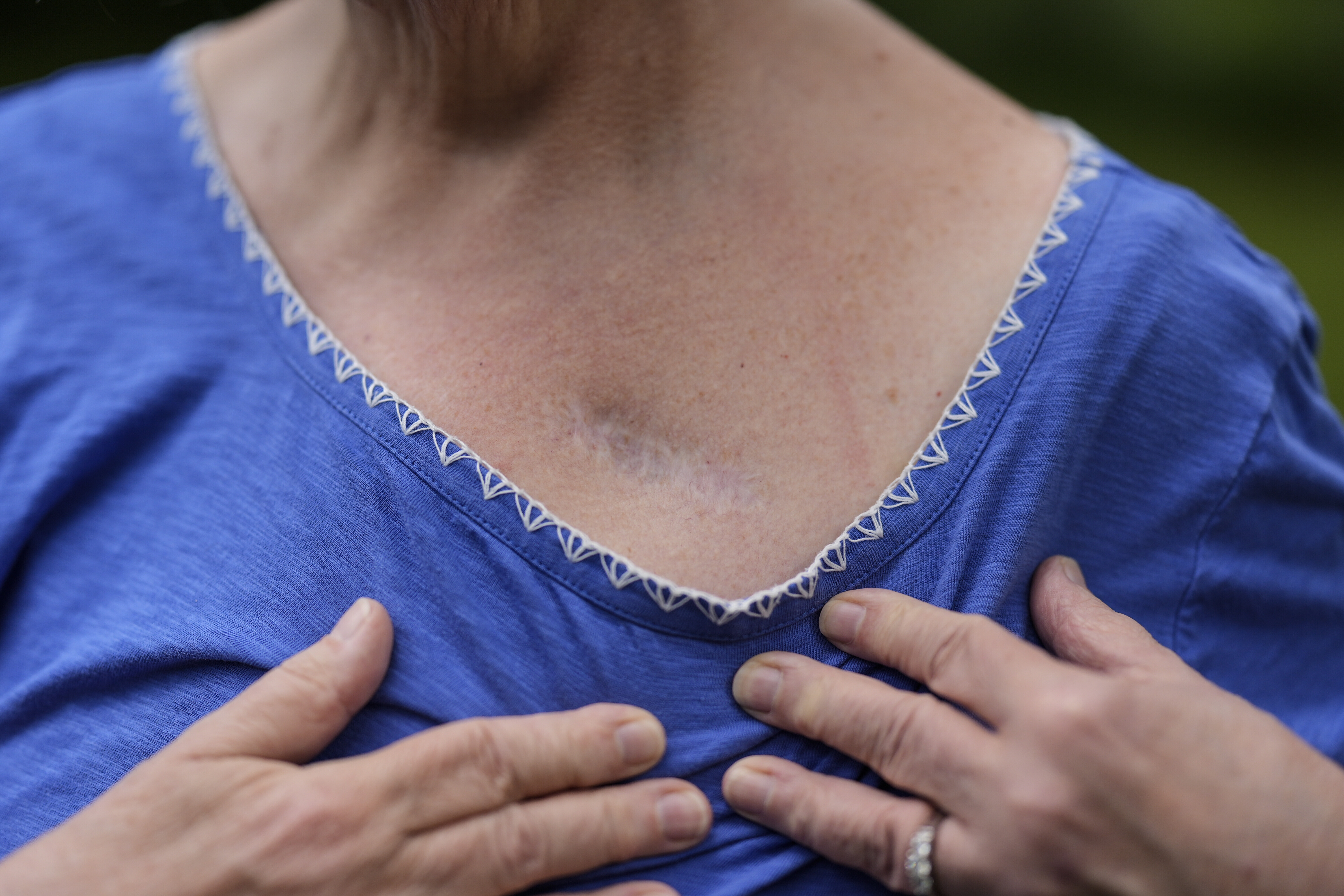 Carol Seegar shows where her deep brain stimulator, powered by an Abbott Brio IPG, was implanted in her body, Thursday, July 24, 2025, in Atlanta. (AP Photo/Mike Stewart)